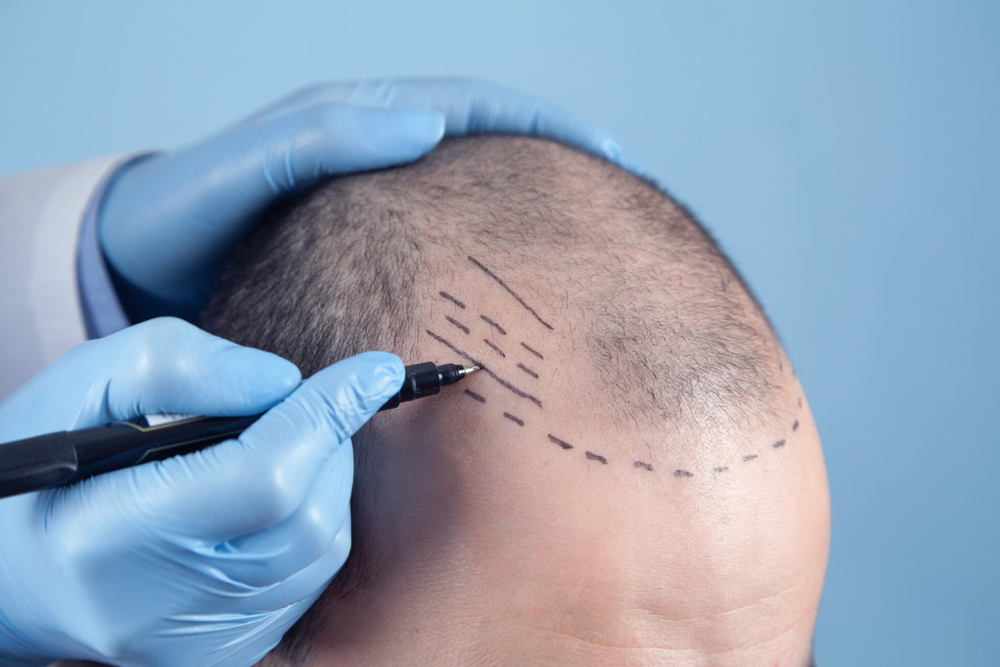 The Advantages of FUE Hair Transplantation Over Traditional Methods