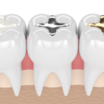 The Lifespan of Dental Fillings: When to Consider Replacement