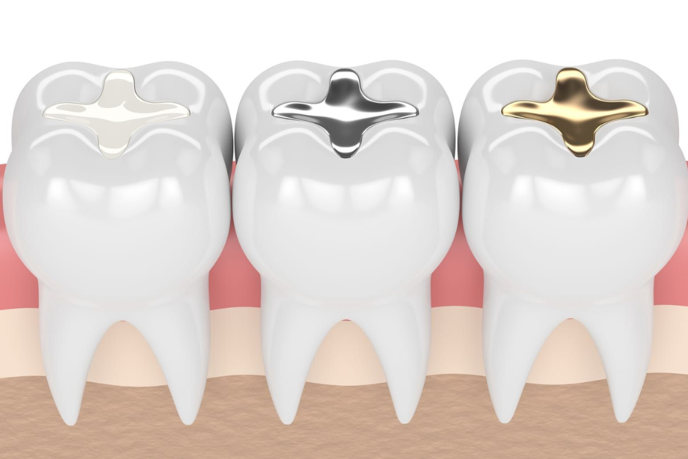 The Lifespan of Dental Fillings: When to Consider Replacement